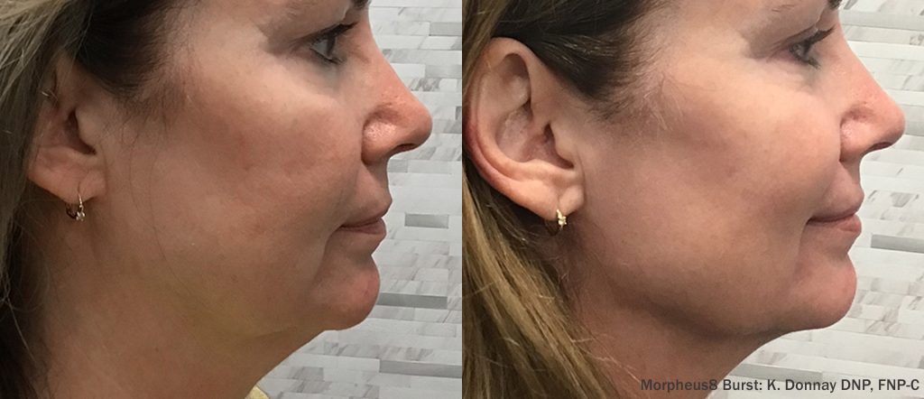 Morpheus8 Burst case study — facial treatment right side view
