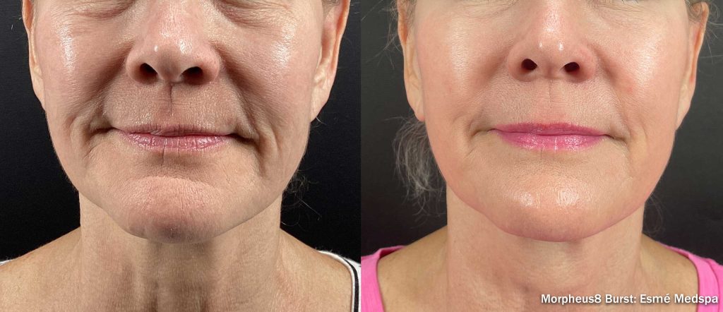 Morpheus8 Burst before and after front view, four treatments