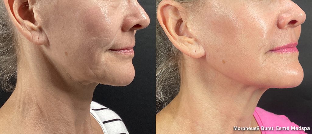 Morpheus8 Burst before and after right side view, four treatments