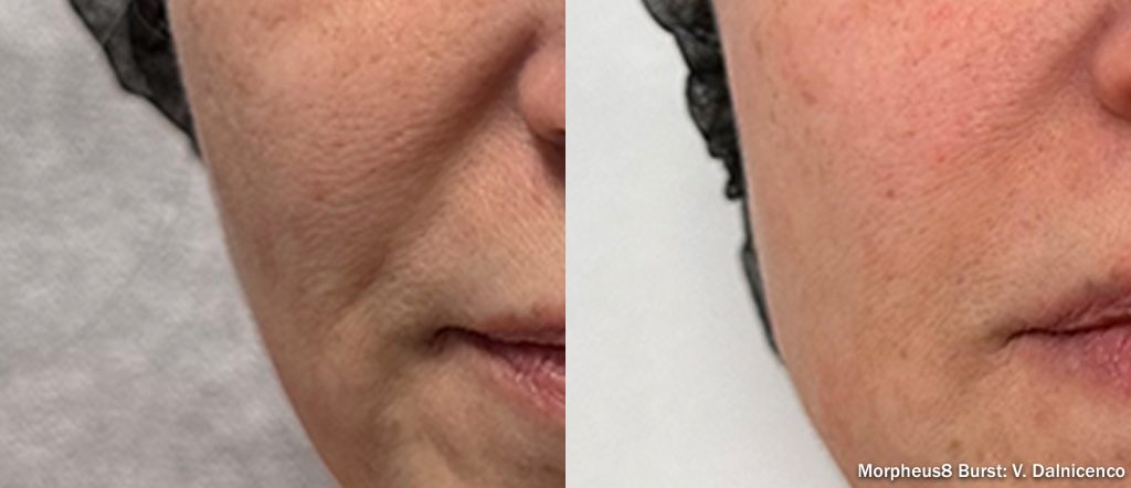 Morpheus8 Burst facial treatment