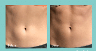 InMode Tone treatment technology