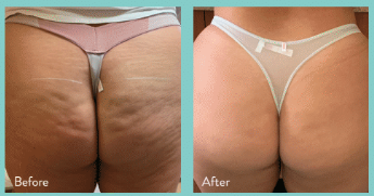 InMode Tone treatment technology