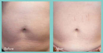 InMode Tone treatment technology