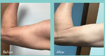 InMode Tone treatment technology