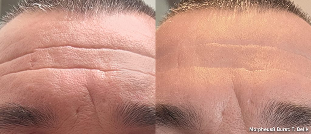 Morpheus8 Burst forehead treatment
