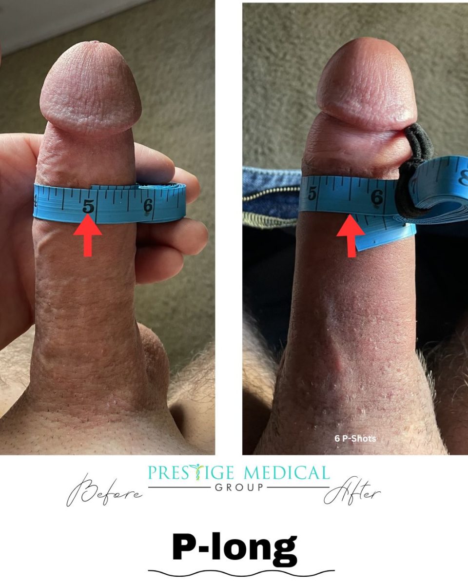 P-Long penile girth before and after result — Prestige Medical Group Tustin CA