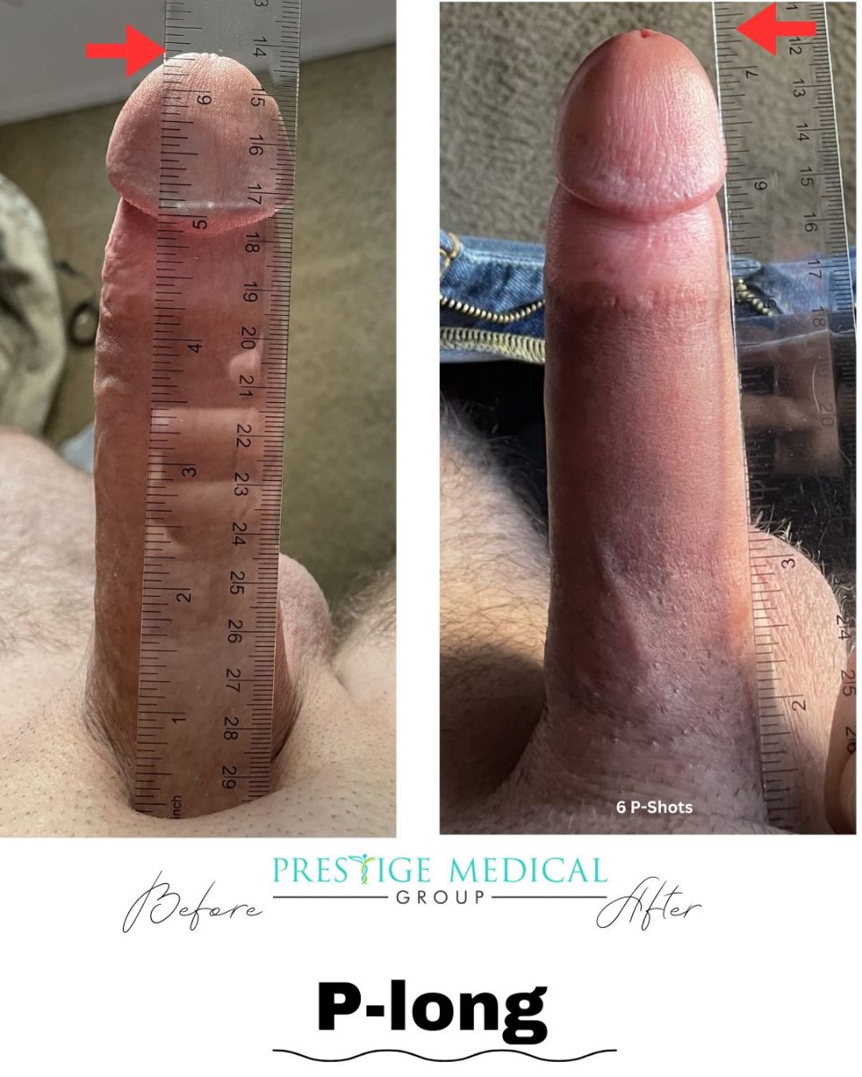 P-Long penile length before and after result — Prestige Medical Group Tustin CA