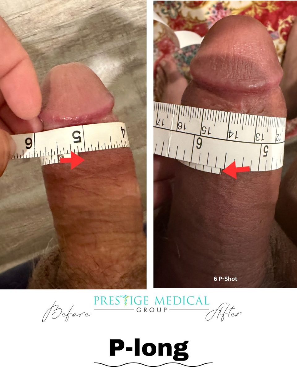 P-Long before and after combined result — Prestige Medical Group Tustin CA