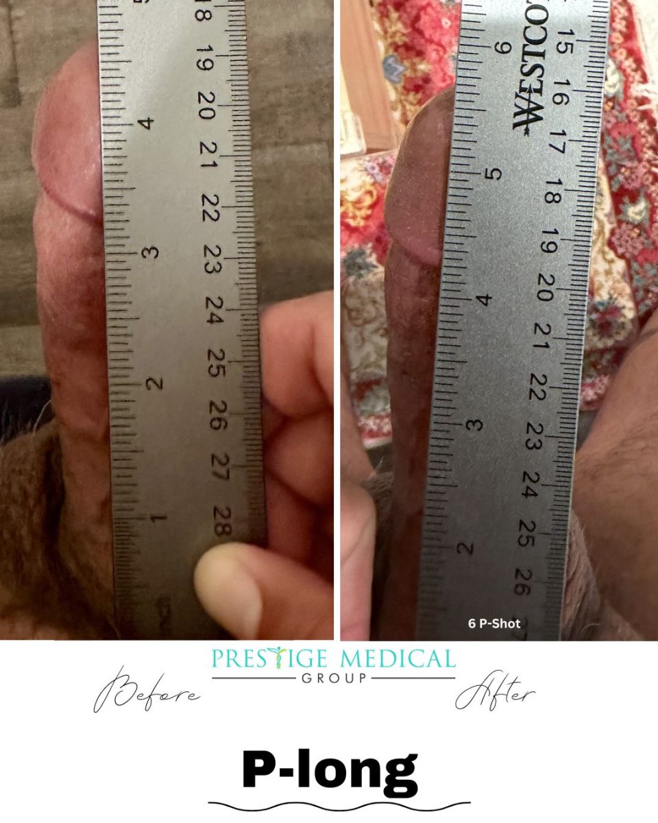 P-Long penile length before and after result — Prestige Medical Group Tustin CA