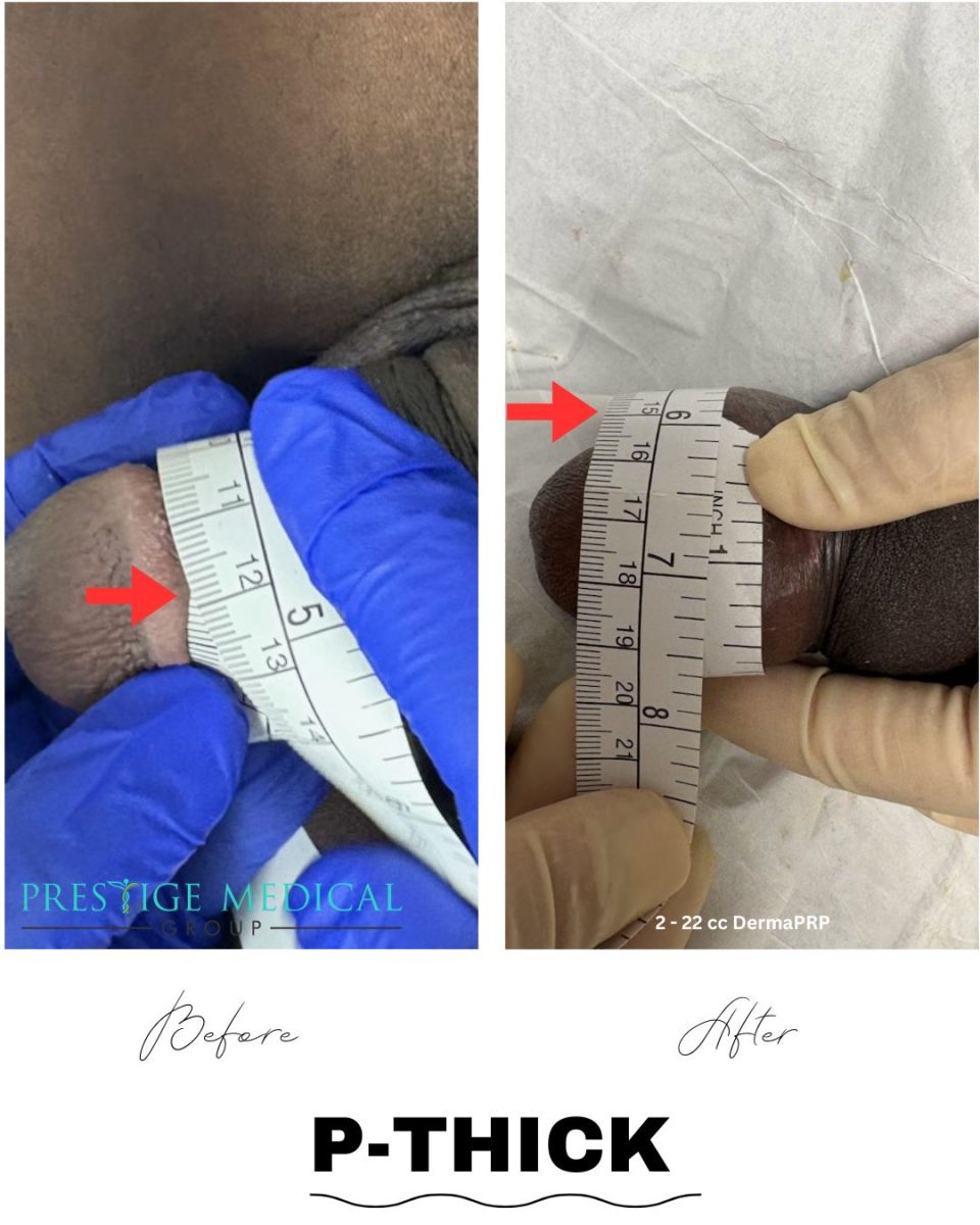 P-Thick before and after — Prestige Medical Group Tustin CA