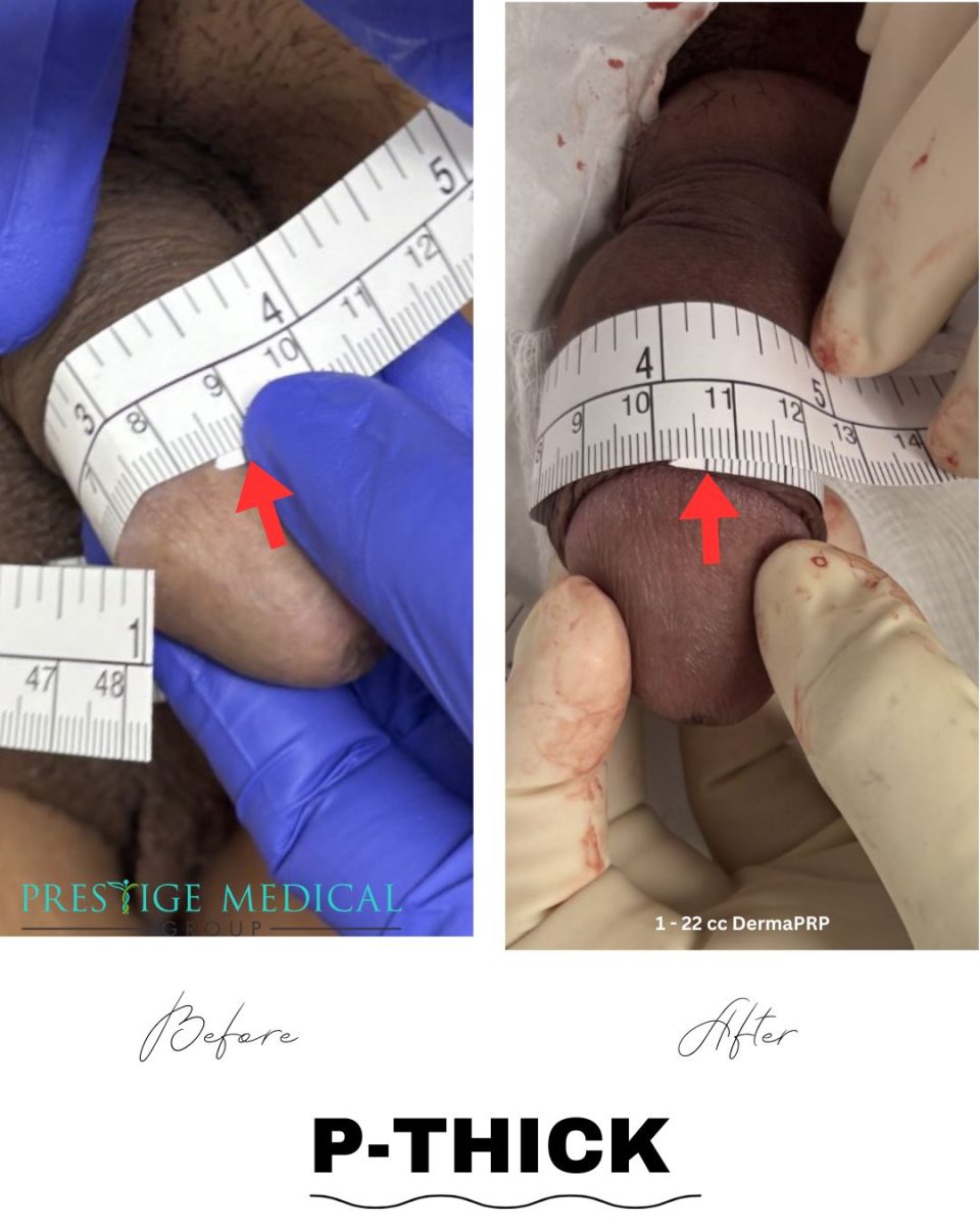P-Thick penile girth enhancement before and after — Prestige Medical Group Tustin CA