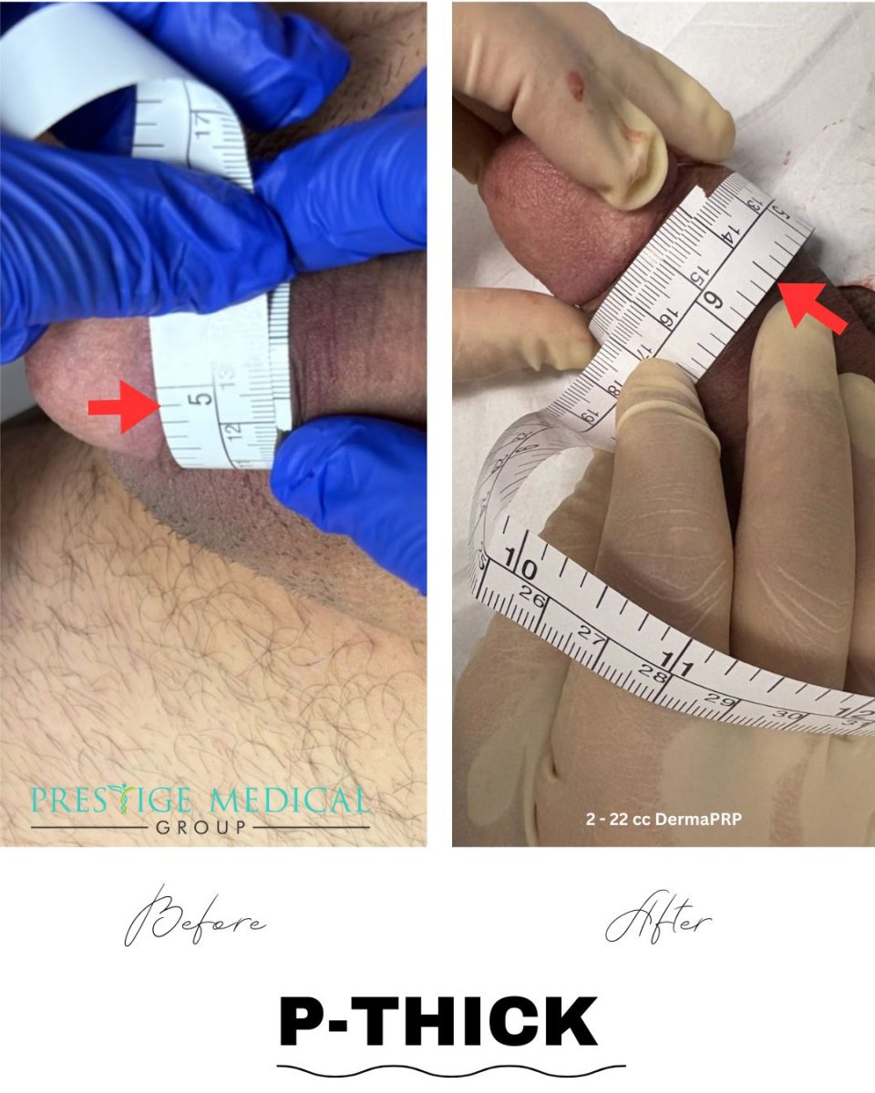 P-Thick penile girth enhancement before and after — Prestige Medical Group Tustin CA