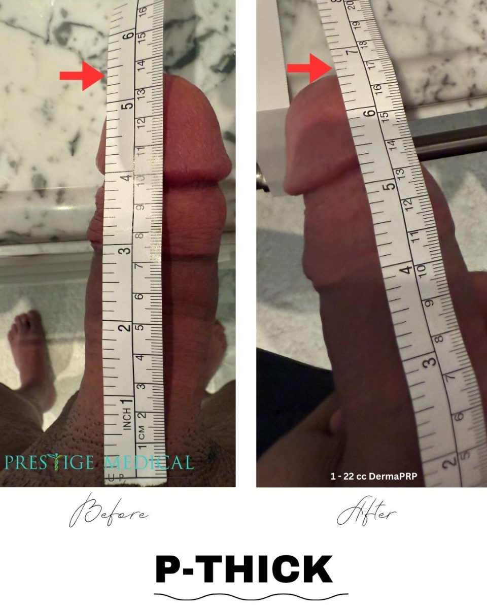 P-Thick penile girth enhancement before and after result — Prestige Medical Group Tustin CA
