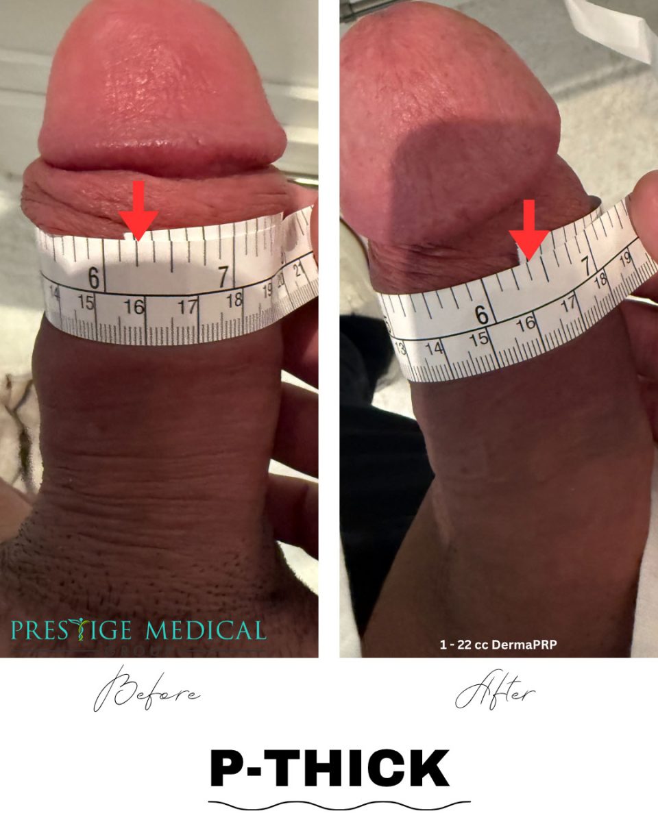 P-Thick penile girth enhancement before and after — Prestige Medical Group Tustin CA